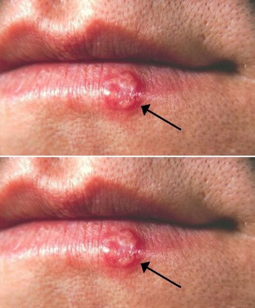 ¿Te salió una ampolla en el labio? Esto es lo que podría estar indicando tu cuerpo y cuándo debes acudir al médico