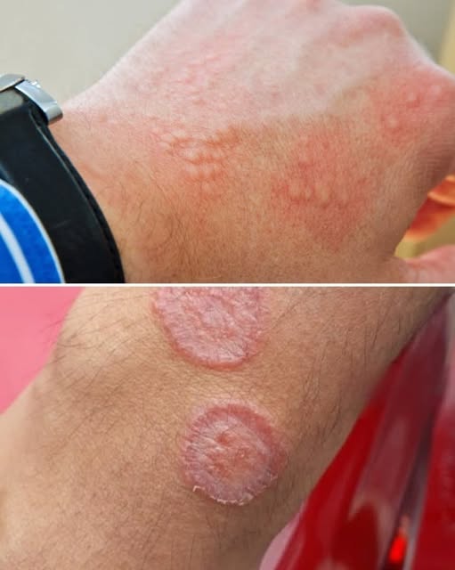 ¿Te han salido manchas circulares en la piel? Estas podrían ser algunas de las causas más comunes