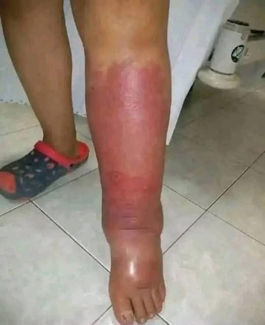 Pierna roja e inflamada: estos son los signos que podrían indicar una infección grave y cuándo buscar atención médica