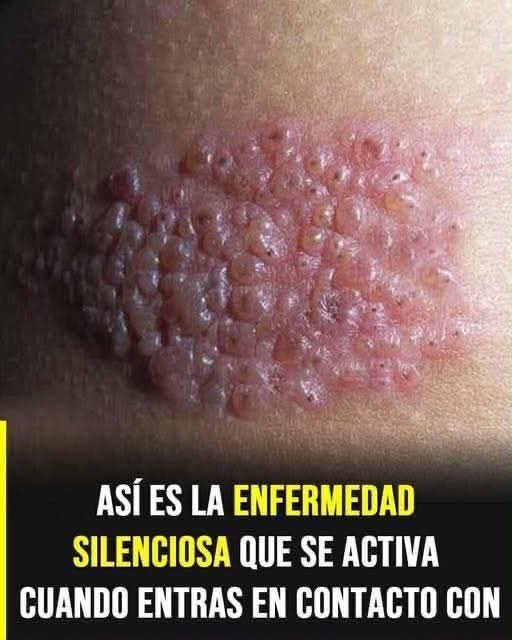 Herpes zóster: la enfermedad que puede reactivarse cuando el sistema inmunológico se debilita
