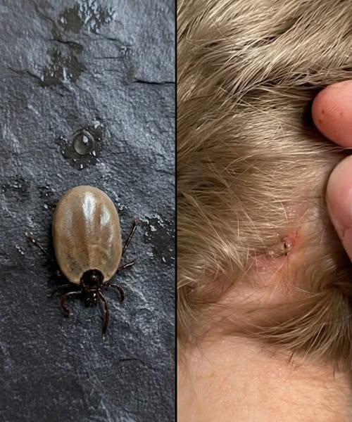 ¿Encontraste este insecto en la cabeza de tu hijo? Lo que debes saber sobre las garrapatas y cómo actuar correctamente