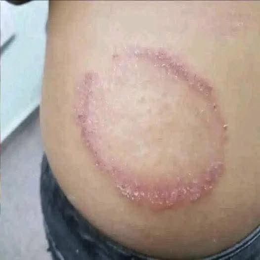 ¿Manchas circulares en la piel? Podrían ser un signo de tiña (dermatofitosis)