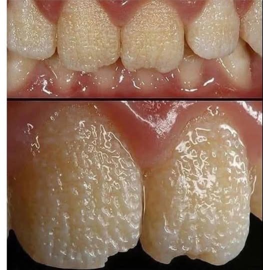 🦷 ¿Tus dientes tienen manchas blancas o surcos? Esto es lo que realmente podrían indicar