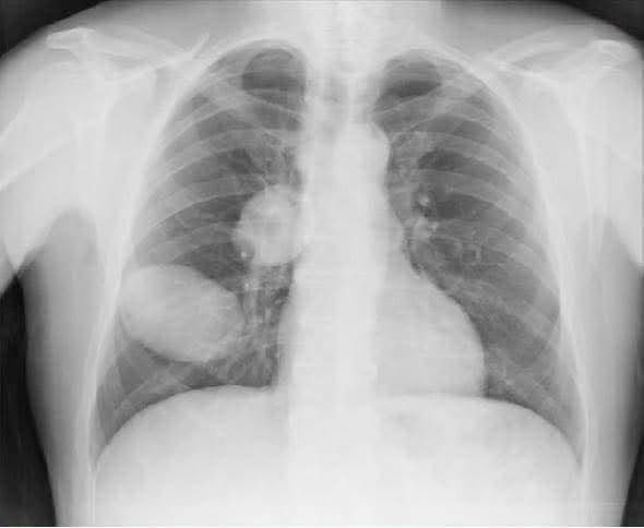 😱 Radiografía revela una masa en el pulmón: ¿qué podría significar realmente?