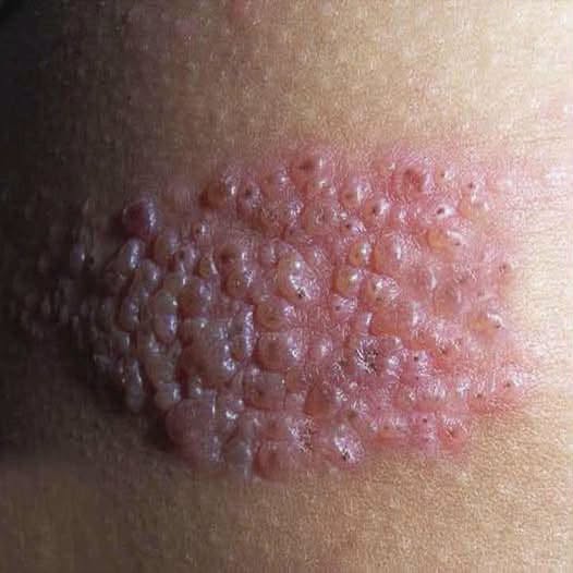 Le picaba todo el cuerpo y creyó que era una alergia, pero el diagnóstico sorprendió a todos