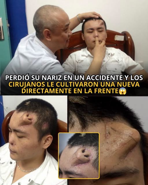 El sorprendente caso del joven que perdió su nariz y la recuperó gracias a una innovadora cirugía reconstructiva