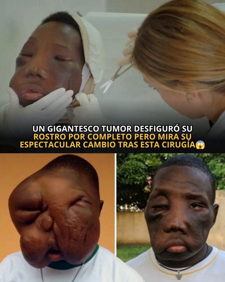 El impresionante caso del joven que recuperó su rostro tras una compleja cirugía reconstructiva en Francia