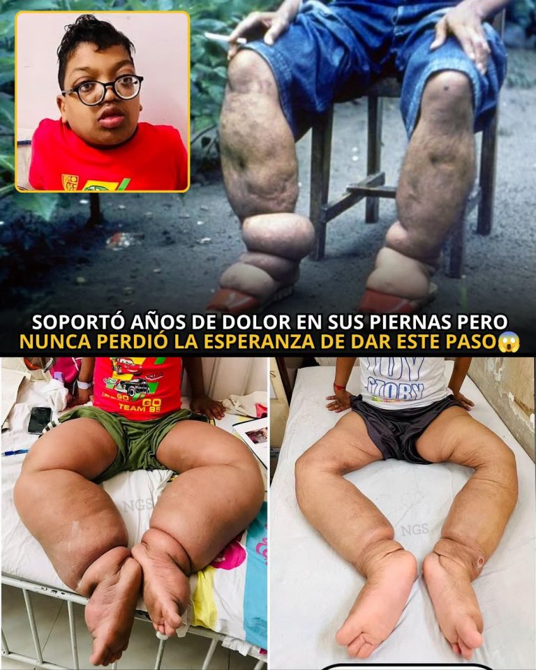 El adolescente que pasó años con un crecimiento extremo en sus piernas y logró recuperar la esperanza gracias a una compleja cirugía