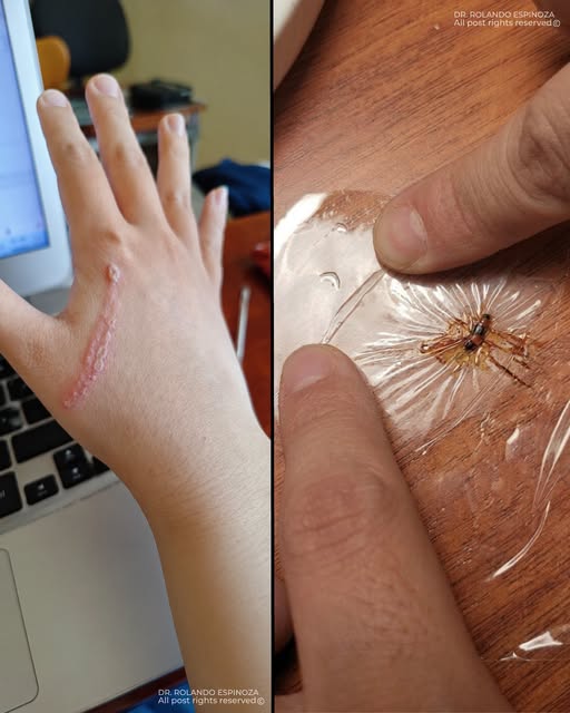 Dermatitis por Paederus: qué es el “fuetazo”, cuáles son sus síntomas y cómo actuar correctamente