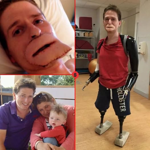 La historia de Alex Lewis: sobrevivió a una infección bacteriana extrema y reconstruyó su vida contra todo pronóstico