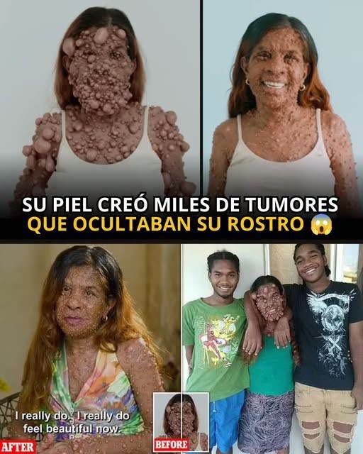 La historia de Charmaine Sahadeo: cómo una enfermedad genética transformó su vida y el tratamiento que le devolvió la esperanza