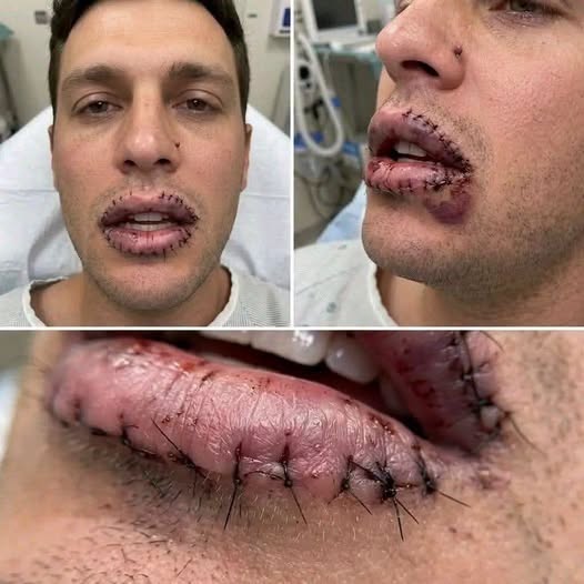 Hace 30 minutos acaban de confirmar qué ocurrió con el hombre que apareció con los labios completamente suturados