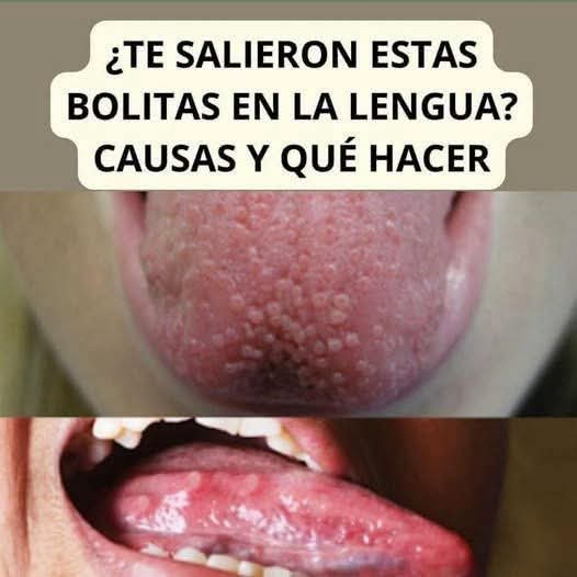 ¿Te salieron bolitas en la lengua? Estas son las causas más comunes y cuándo debes consultar al médico