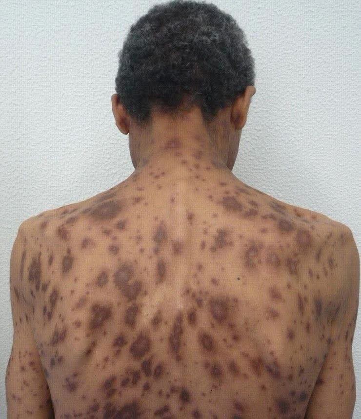 Manchas oscuras en la piel: posibles causas y cuándo debes consultar a un médico