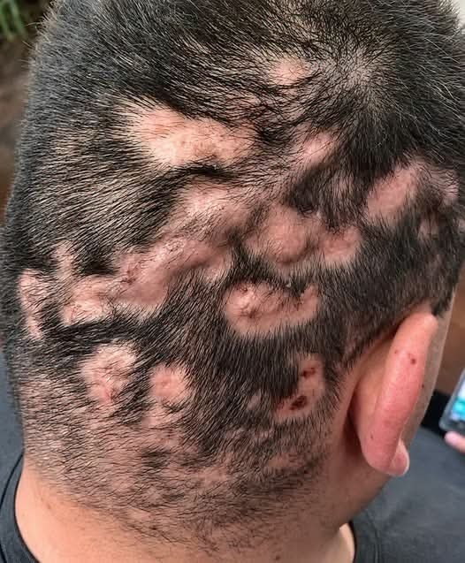 ¿Aparecen manchas sin cabello en la cabeza? Estas podrían ser las causas y cuándo debes acudir al médico