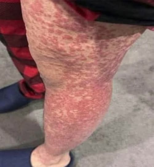 ¿Dormir con un calentador, manta eléctrica o fuente de calor puede provocar manchas en la piel? Médicos explican qué hay detrás de esta condición y cómo prevenirla