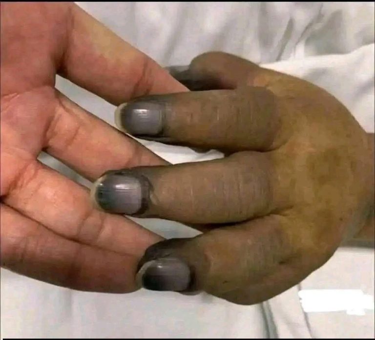⚠️ ¿Pintarse las uñas puede provocar que se vuelvan negras? Esto es lo que realmente muestran las imágenes virales
