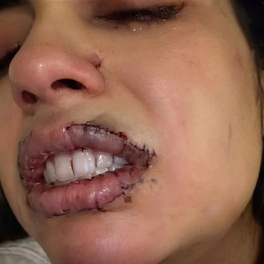 “Hace dos minutos acaba de pasar…”: la verdad detrás de la impactante imagen de una mujer con heridas en el rostro