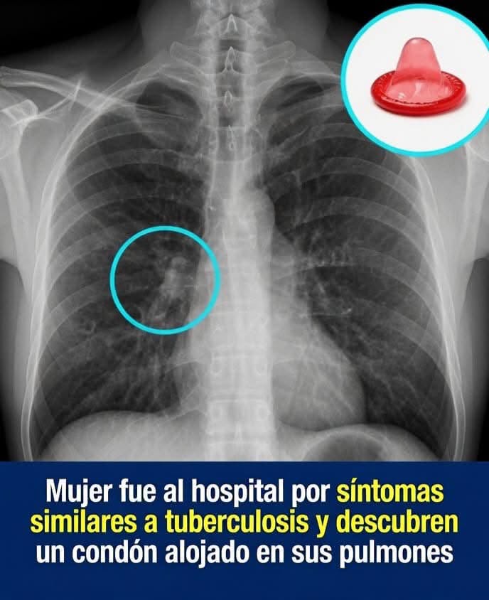 Maestra fue tratada por tuberculosis, pero tenía un preservativo alojado en un bronquio