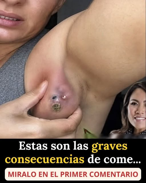 Estas son las graves consecuencias que muchos atribuyen a ciertos alimentos: la verdad sobre los bultos dolorosos y abscesos en la axila