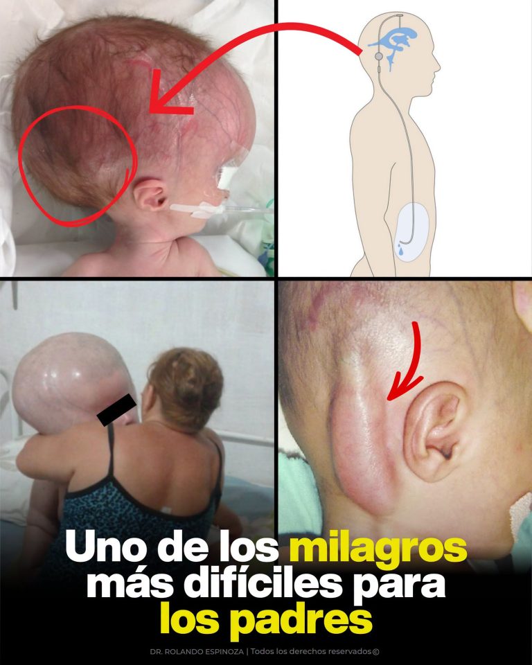 Hidrocefalia en bebés: qué es, por qué ocurre y cómo puede cambiar la vida de una familia