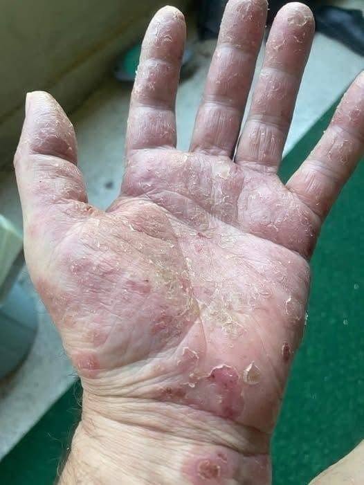 Señales en las manos que pueden alertarte de que algo no está bien en tu piel