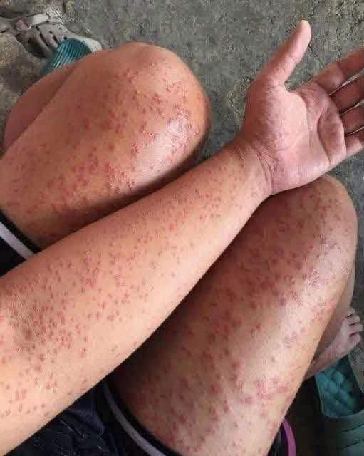 Consecuencias de dormir sin higiene adecuada: lo que realmente puede provocar manchas y brotes en la piel