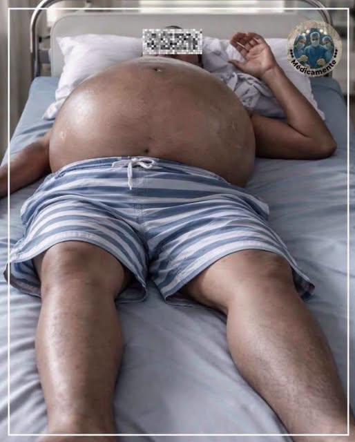 Así puede verse el abdomen cuando el hígado está gravemente afectado: señales que no deben ignorarse