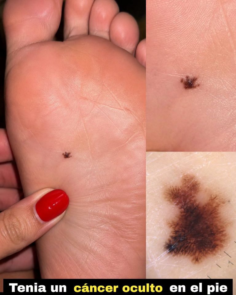 Tenía cáncer oculto en la planta del pie durante años: la señal que terminó revelando un melanoma