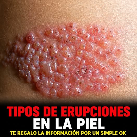 Herpes zóster: por qué puede aparecer de repente y cuáles son sus principales señales