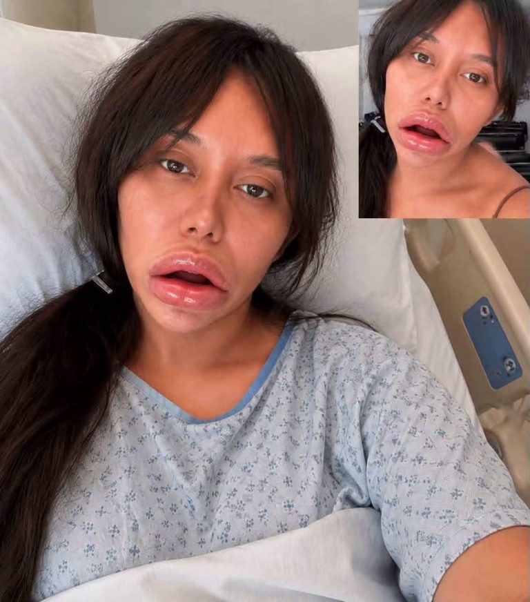Joven denuncia complicaciones tras someterse a un procedimiento estético en los labios