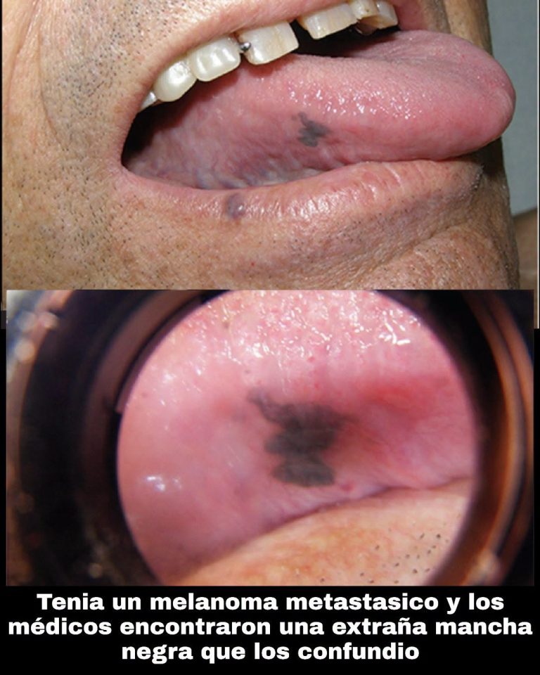 Extraña mancha negra en la lengua sorprende a médicos durante una revisión