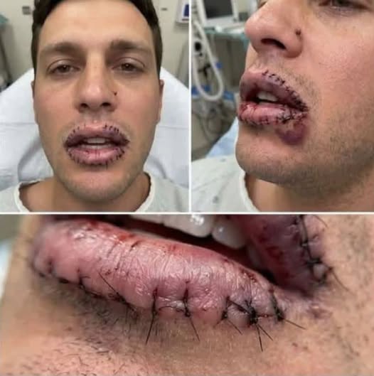 Lo que puede provocar una reacción intensa en los labios después de comer pollo frito