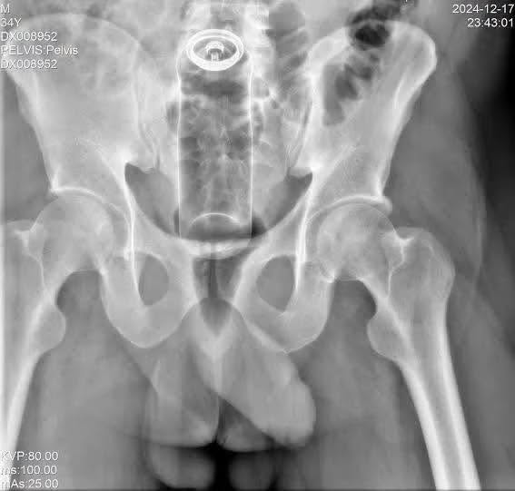 Una lesión interna que pasó desapercibida hasta que los médicos descubrieron la causa