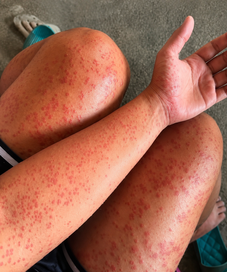 CONSECUENCIAS DE DORMIR CON INSECTOS EN TU HABITACIÓN: LAS SEÑALES QUE PUEDEN APARECER EN TU PIEL