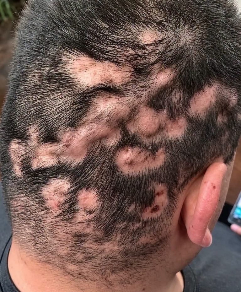 ¿Por qué aparecen zonas sin cabello en la cabeza? Estas son las posibles causas y los primeros síntomas