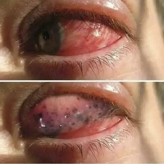 ¿Dormir con un lente de contacto puede poner en riesgo tu visión? Estas son las consecuencias que debes conocer