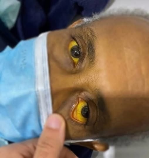 Si notas los ojos amarillos, tu cuerpo podría estar enviándote una señal importante