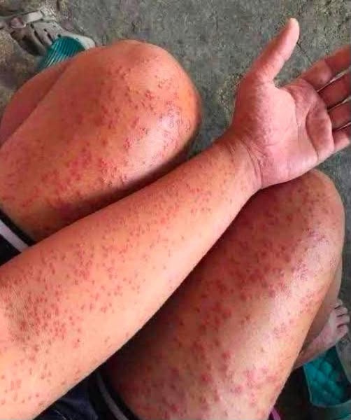 Estas manchas en brazos y piernas pueden aparecer por diferentes razones