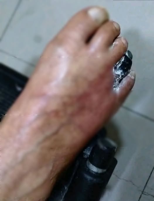 ¿Dormir con un hongo en las uñas puede provocar complicaciones? Lo que debes saber para proteger tus pies