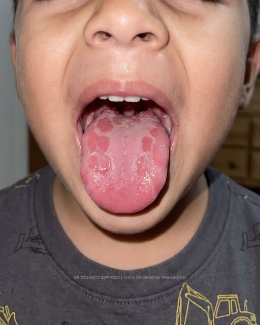 Parches rojos en la lengua de los niños: esto es lo que pueden significar