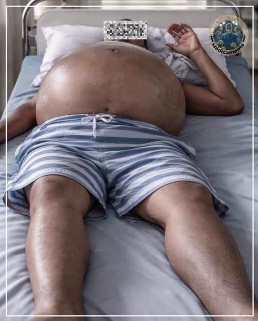 Así puede cambiar el abdomen cuando el hígado comienza a presentar complicaciones