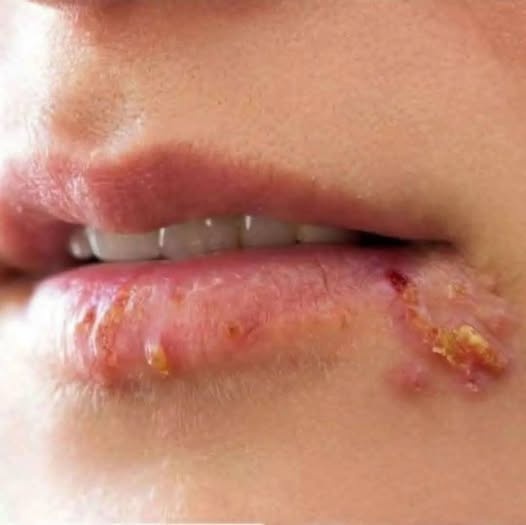 Estas lesiones en los labios pueden tener varias causas y conviene reconocer las señales