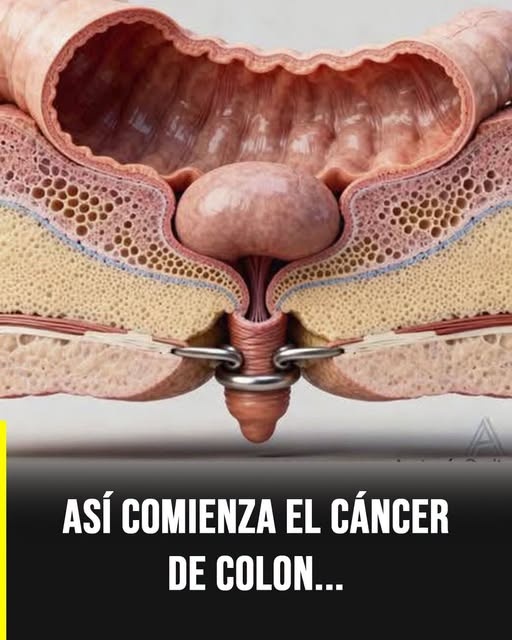 ESTAS SEÑALES DEL COLON PUEDEN PASAR DESAPERCIBIDAS