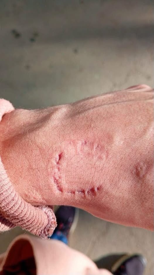 UN ESTUDIANTE TERMINÓ CON UNA EXTRAÑA MARCA EN EL BRAZO