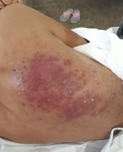 DORMIR SIN PROTECCIÓN ADECUADA PUEDE AFECTAR TU PIEL