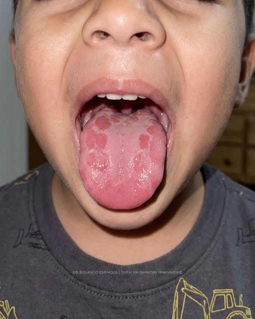 PARCHES EN LA LENGUA DE LOS NIÑOS: QUÉ PUEDEN SIGNIFICAR Y CUÁNDO CONSULTAR