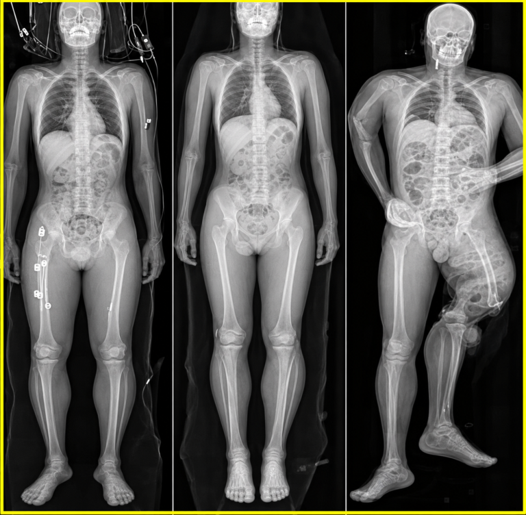 COVID-19 Y VACUNAS: QUÉ SE SABE SOBRE LOS RUMORES DE UN SUPUESTO NUEVO CÁNCER